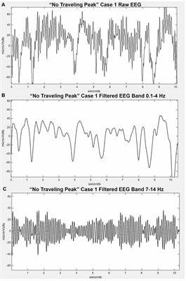 Brainstem Influence on Thalamocortical Oscillations during Anesthesia Emergence